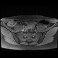 Atypical deep infiltrating endometriosis (Radiopaedia 44470-48125 Axial T1 fat sat 2).jpg