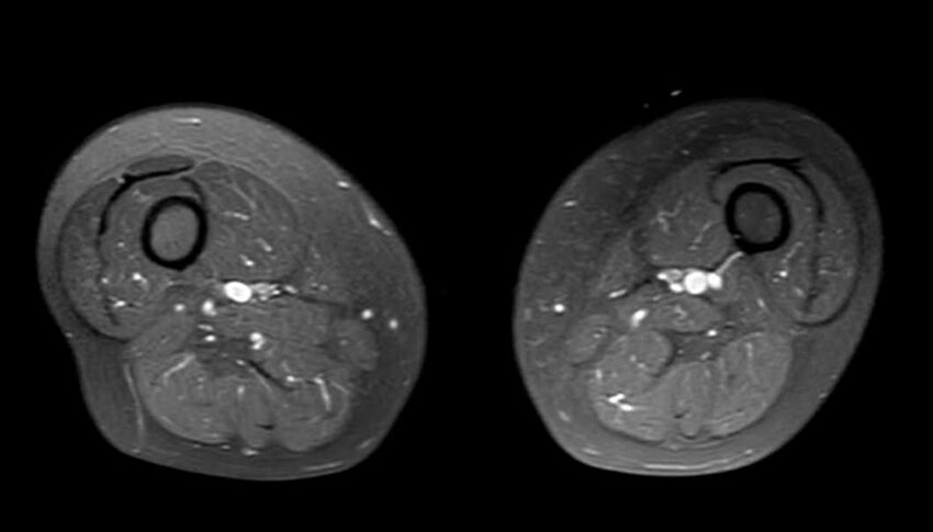Atypical lipomatous tumor - thigh (Radiopaedia 68975-78734 Axial PD fat sat 40).jpg