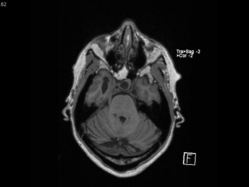 Atypical meningioma - intraosseous (Radiopaedia 64915-74572 Axial T1 82).jpg