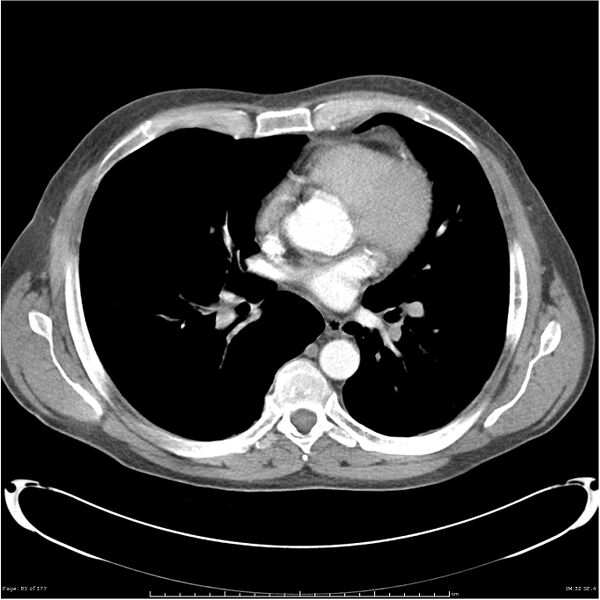 File:Atypical pneumonia - Q fever (Radiopaedia 21993-21989 C+ arterial phase 27).jpg