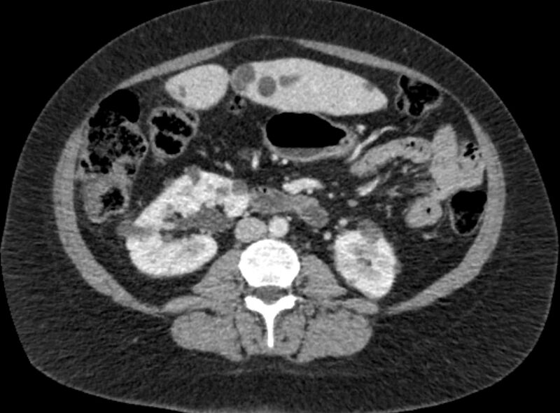 File:Autosomal dominant polycystic kidney disease (Radiopaedia 57124-64017 A 61).jpg