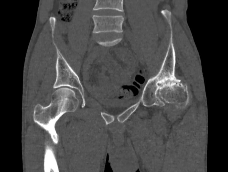 File:Avascular necrosis of the left hip (Radiopaedia 75068-86125 Coronal bone window 20).jpg