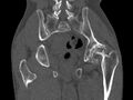 Avascular necrosis of the left hip (Radiopaedia 75068-86125 Coronal bone window 59).jpg