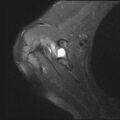 Avulsion fracture - greater tuberosity of humerus (Radiopaedia 71216-81515 Axial PD fat sat 15).jpg