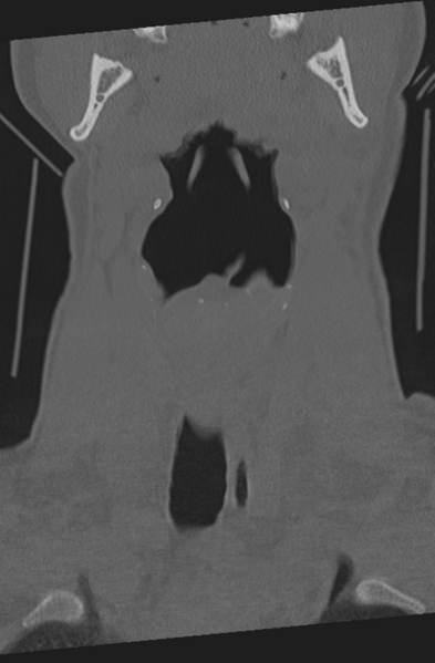 File:Axis peg fracture (type 3) and atlas lateral mass (type 4) fracture (Radiopaedia 37474-39324 Coronal bone window 2).png