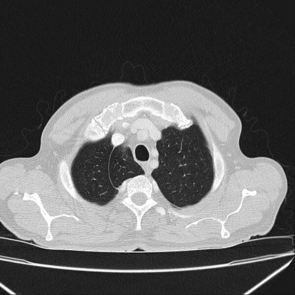 File:Azygos lobe (Radiopaedia 38259-40275 Axial lung window 11).jpg