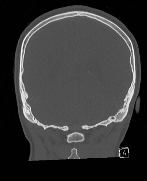 File:Base of skull fracture with bilateral Le Fort fractures (Radiopaedia 47094-51638 Coronal bone window 28).jpg