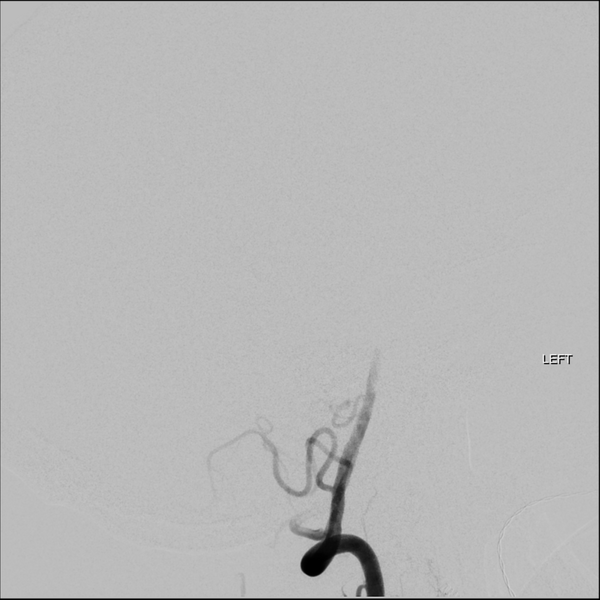 File:Basilar tip thrombus with endovascular clot retrieval (Radiopaedia 46320-50726 A 7).png