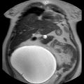 Benign seromucinous cystadenoma of the ovary (Radiopaedia 71065-81300 Coronal T2 16).jpg