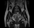Bicornuate bicollis uterus (Radiopaedia 61626-69616 Coronal T2 16).jpg