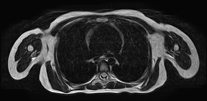 File:Bilateral Sprengel deformity with Klippel-Feil syndrome (Radiopaedia 66395-75650 Axial T2 30).jpg