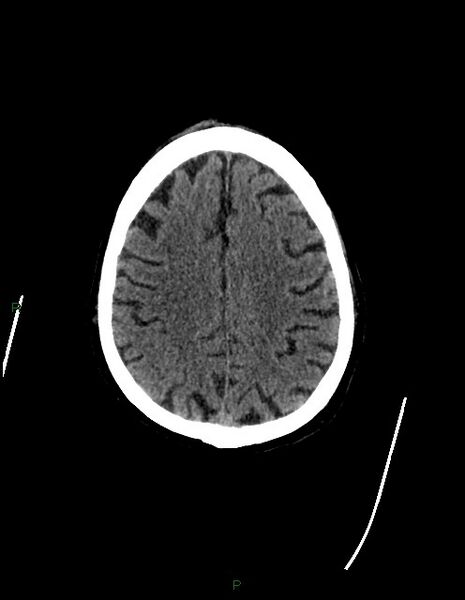 File:Bilateral acute middle cerebral artery territory infarcts (Radiopaedia 77319-89401 Axial non-contrast 65).jpg