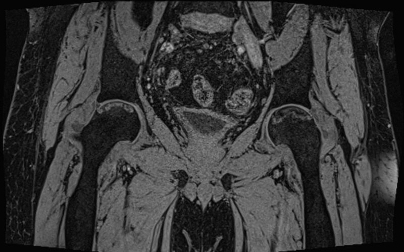 File:Bilateral avascular necrosis of femoral head (Radiopaedia 77116-89078 Coronal T2 we 39).jpg
