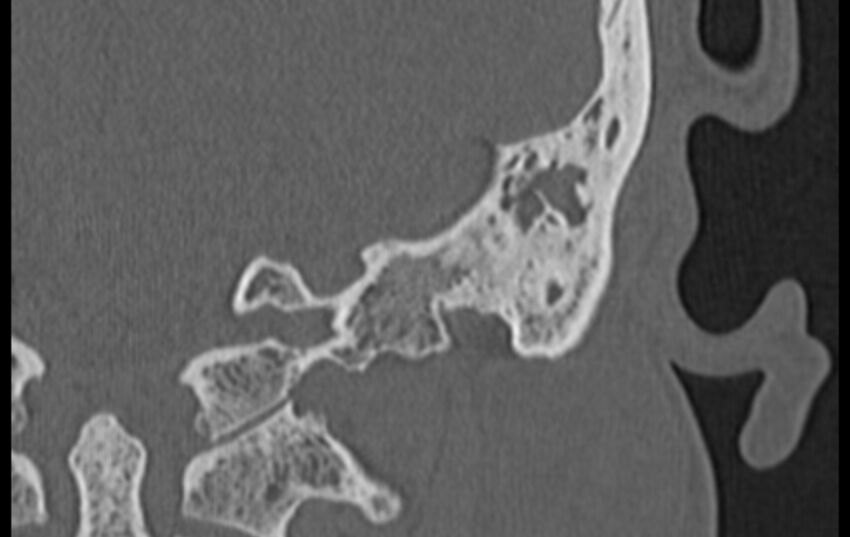 Bilateral cholesteatoma (Radiopaedia 54898-61172 D 48).jpg