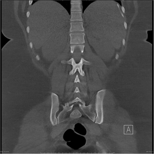 File:Bilateral lumbar ribs (Radiopaedia 25862-26010 Coronal bone window 15).jpg