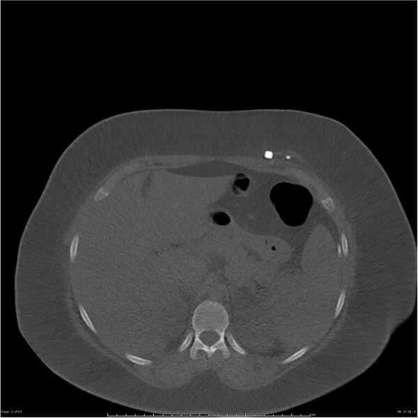 File:Bilateral lumbar ribs (Radiopaedia 25862-26010 bone window 2).jpg