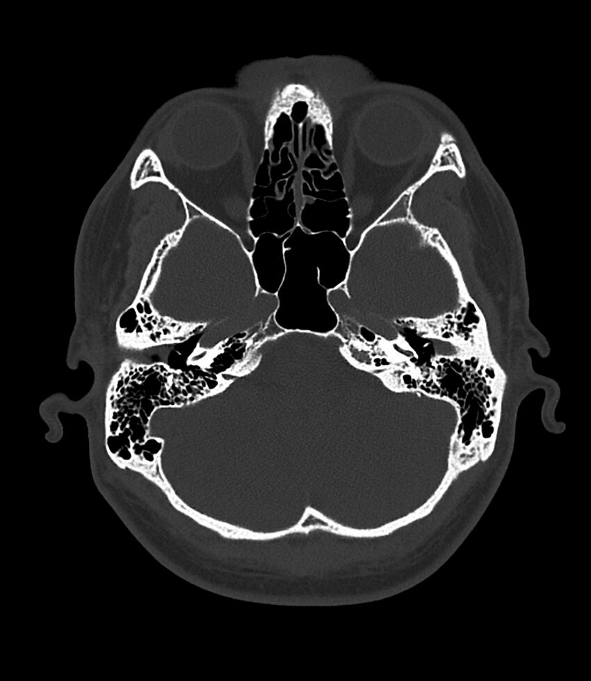 Bilateral medial canal fibrosis (Radiopaedia 85598-101344 Axial bone window 34).jpg