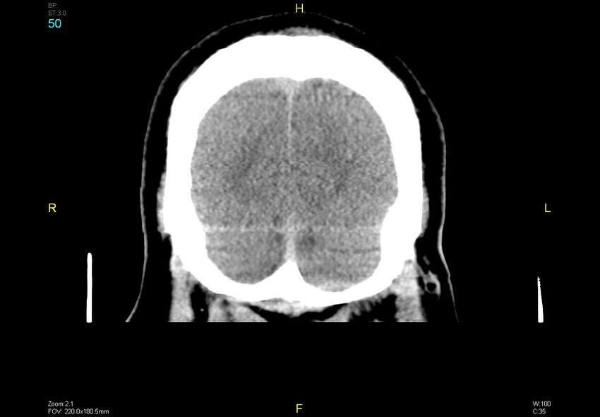 Bilateral medial medullary infarction (Radiopaedia 42220-45295 Coronal non-contrast 50).jpg