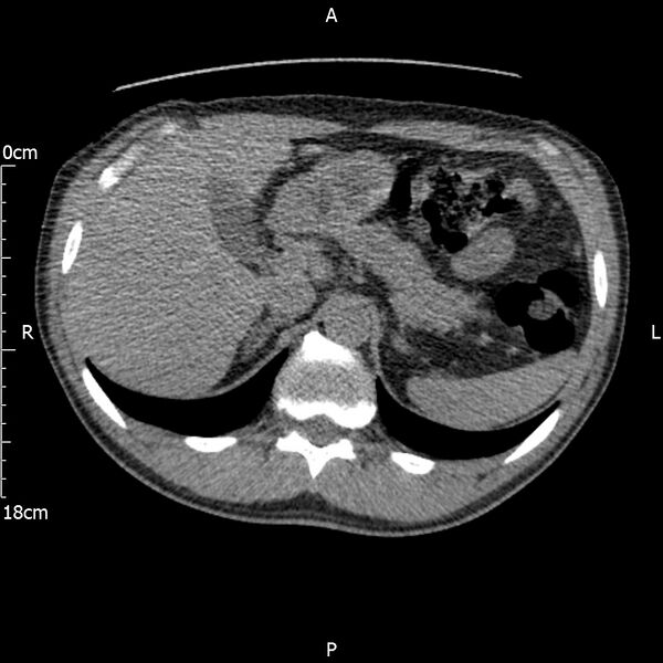 File:Bilateral medullary nephrocalcinosis with ureteric calculi (Radiopaedia 71269-81569 Axial non-contrast 23).jpg