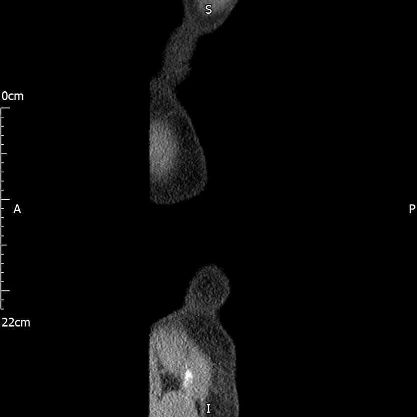 Bilateral medullary nephrocalcinosis with ureteric calculi (Radiopaedia 71269-81569 C 6).jpg