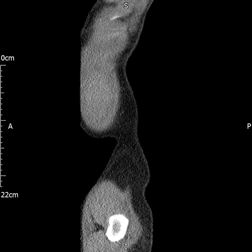 Bilateral medullary nephrocalcinosis with ureteric calculi (Radiopaedia 71269-81569 C 9).jpg