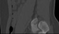 Bilateral pars defect (Radiopaedia 26691-26846 Sagittal bone window 54).jpg
