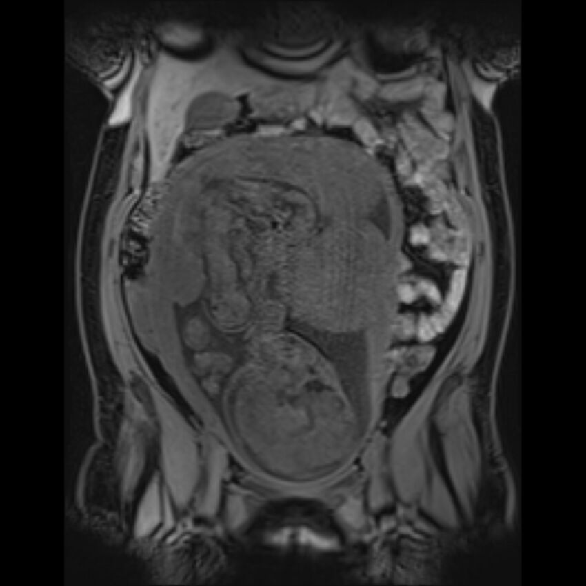 Bilobed placenta accreta (Radiopaedia 69648-79591 Coronal T1 vibe 71).jpg