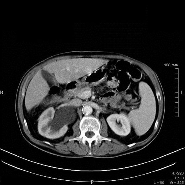 File:Bladder squamous cell carcinoma (Radiopaedia 14130-13984 A 1).jpg