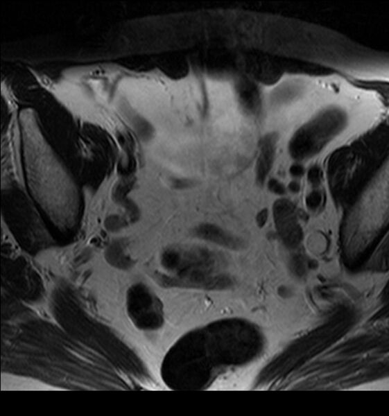 File:Bladder tumor detected on trauma CT (Radiopaedia 51809-57639 Axial T2 1).jpg