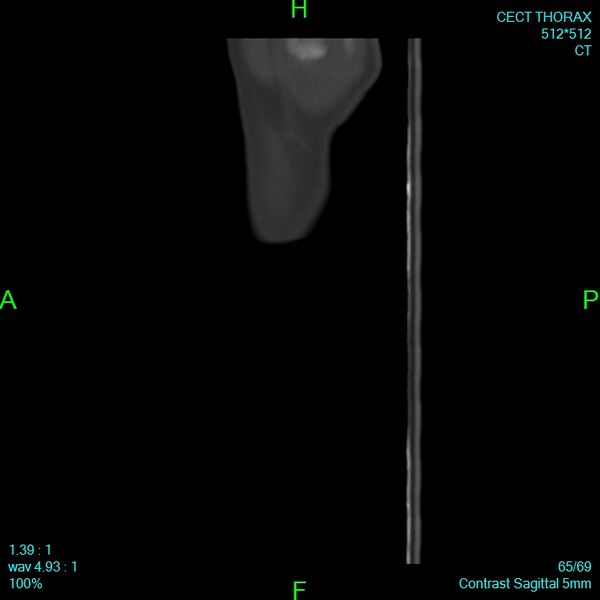 File:Bone metastases from lung carcinoma (Radiopaedia 54703-60937 Sagittal bone window 65).jpg