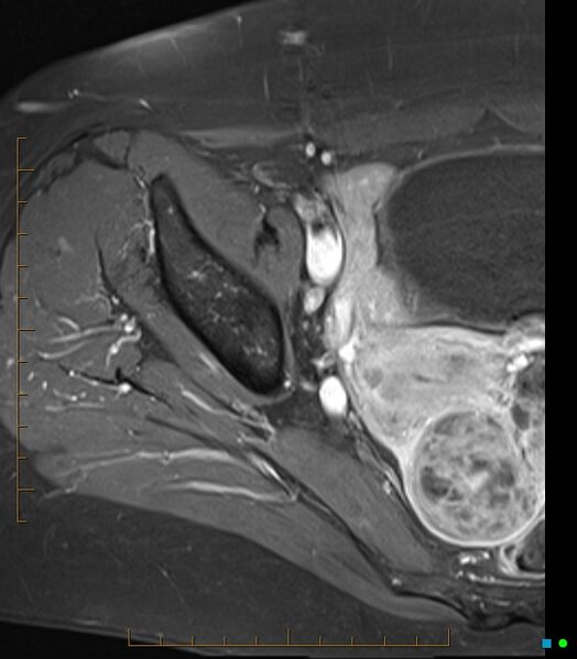 File:Bone metastasis - breast cancer (Radiopaedia 16667-16374 Axial T1 C+ fat sat 19).jpg