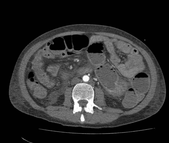 File:Bowel lymphoma complicated by bleeding after therapy (Radiopaedia 55601-62110 B 41).jpg