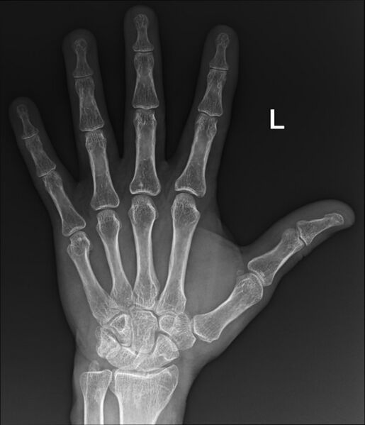 File:Boxer's fracture (Radiopaedia 67094-76431 Frontal 1).jpg