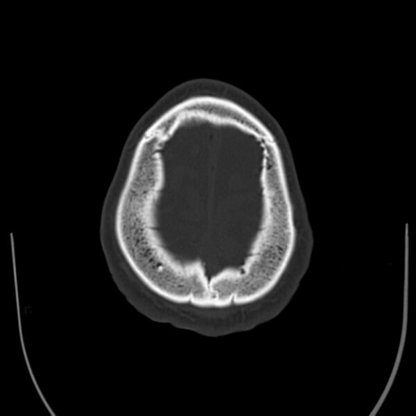 File:Brain Pantopaque remnants (Radiopaedia 78403-91048 Axial bone window 61).jpg