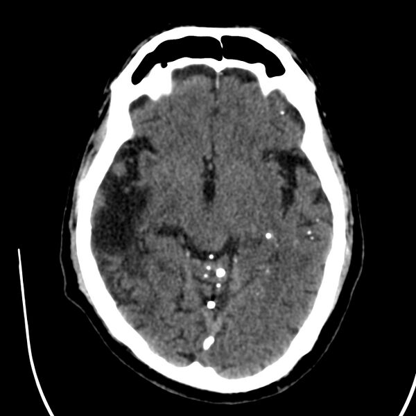 File:Brain Pantopaque remnants (Radiopaedia 78403-91048 Axial non-contrast 45).jpg