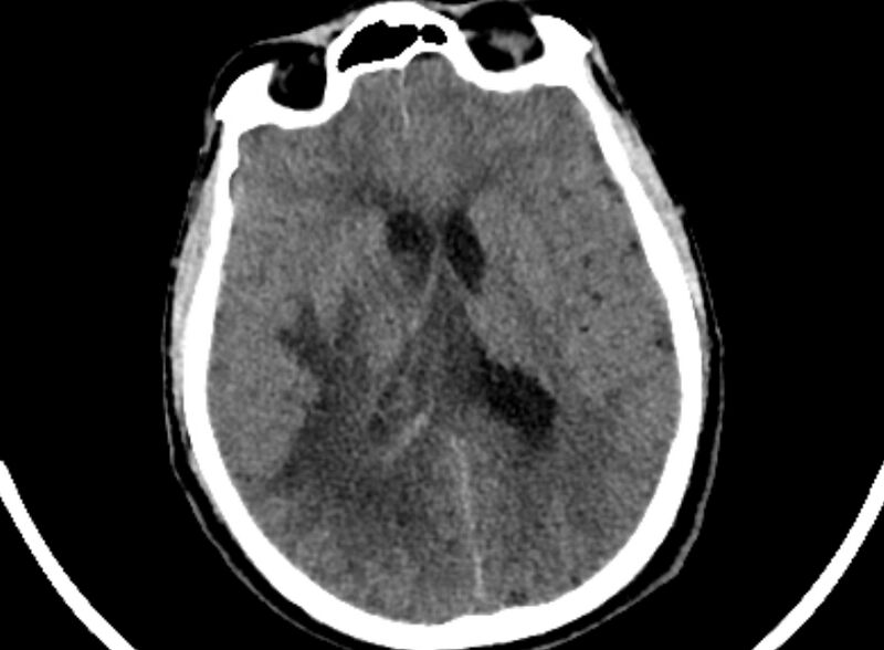 File:Brain abscess complicated by intraventricular rupture and ventriculitis (Radiopaedia 82434-96575 Axial non-contrast 52).jpg
