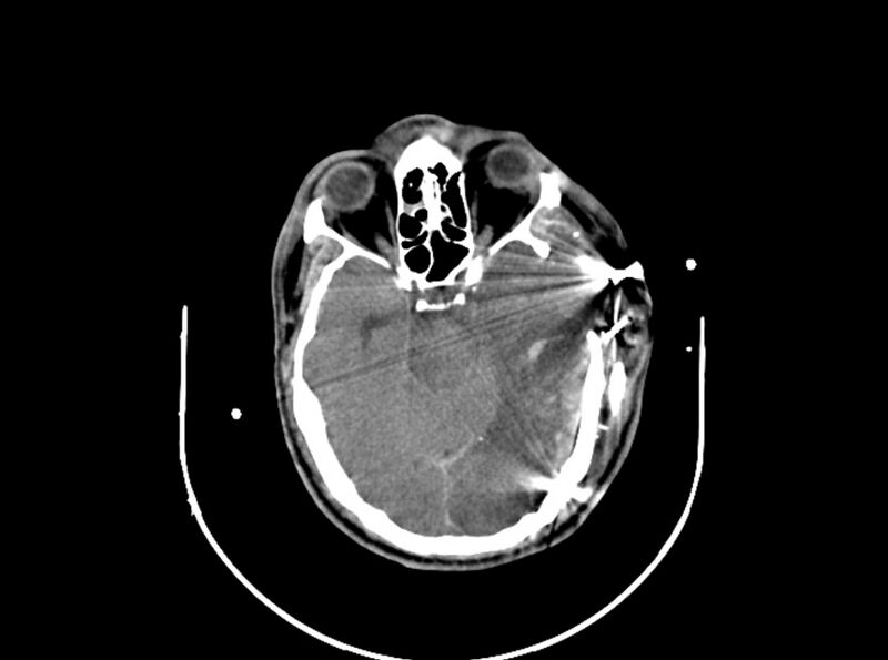 File:Brain injury by firearm projectile (Radiopaedia 82068-96087 B 83).jpg