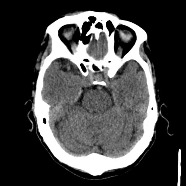 File:Brain metastases from lung cancer (Radiopaedia 27849-28092 Axial non-contrast 16).jpg