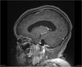 Brainstem glioma (Radiopaedia 21819-21775 D 28).jpg