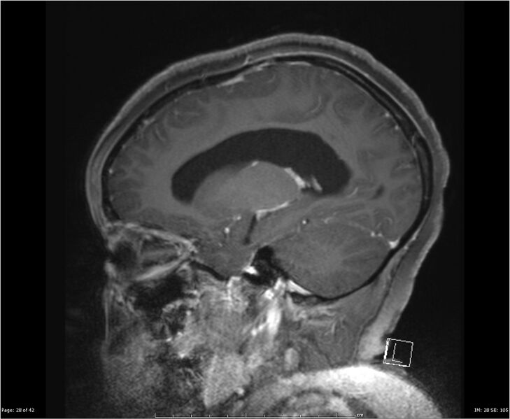 File:Brainstem glioma (Radiopaedia 21819-21775 D 28).jpg