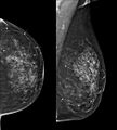 Breast hamartoma (Radiopaedia 85726-101583 Left CC and MLO 1).jpg