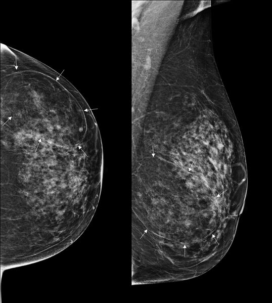 File:Breast hamartoma (Radiopaedia 85726-101583 Left CC and MLO 1).jpg