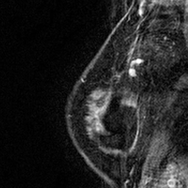 File:Breast implants - MRI (Radiopaedia 26864-27035 Sagittal T2 117).jpg