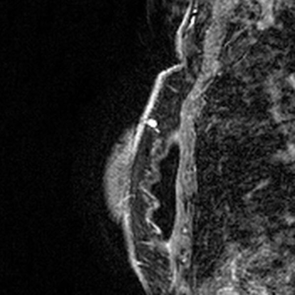 File:Breast implants - MRI (Radiopaedia 26864-27035 Sagittal T2 82).jpg