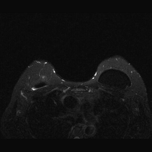 File:Breast implants - MRI (Radiopaedia 26864-27035 T2 SPAIR 39).jpg