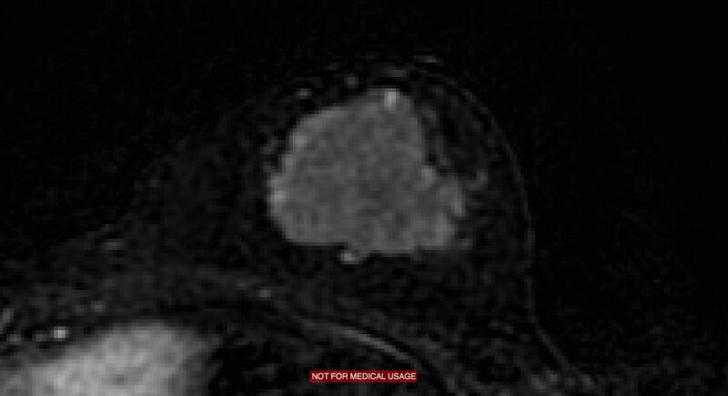 File:Breast lymphoma (MRI) (Radiopaedia 34999-36498 C 10).jpg