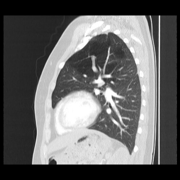 File:Bronchial atresia (Radiopaedia 22965-22992 Sagittal lung window 19).jpg