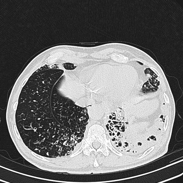 File:Bronchiectasis (Radiopaedia 22061-22059 lung window 24).jpg