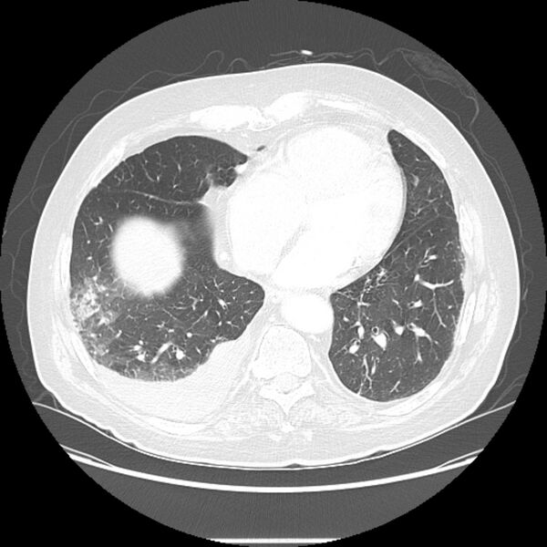 File:Bronchogenic adenocarcinoma and pulmonary embolism (Radiopaedia 9097-9806 Axial lung window 21).jpg