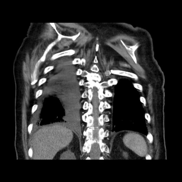 File:Bronchogenic adenocarcinoma and pulmonary embolism (Radiopaedia 9097-9806 C 43).jpg